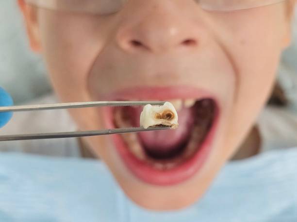 Best Emergency Tooth Extraction in Pocahontas, AR
